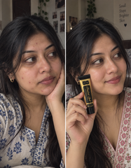 Breakout Spell (Acne Treatment)